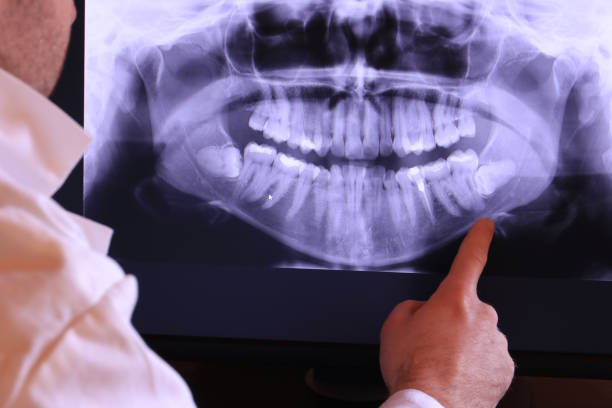 Best Emergency Dentist for Lost Fillings or Crowns in Salix, PA